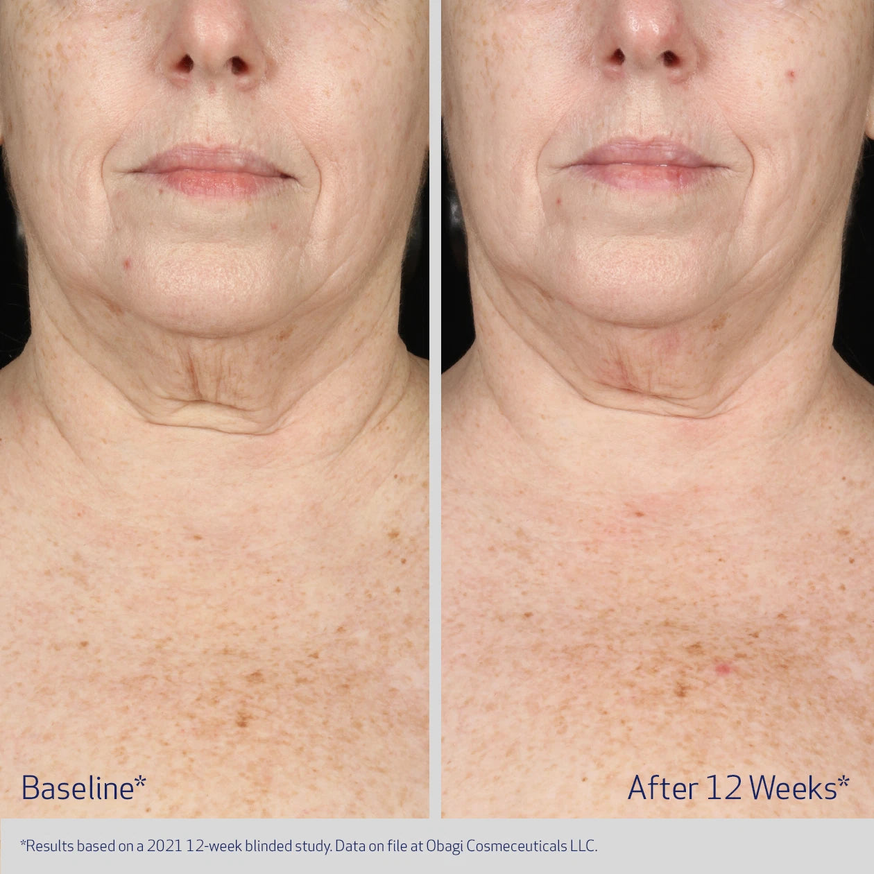 Obagi ELASTIderm Neck and Décolleté Concentrate before and after for neck and chest, advanced formula for visibly firmer, smoother, more youthful-looking skin.