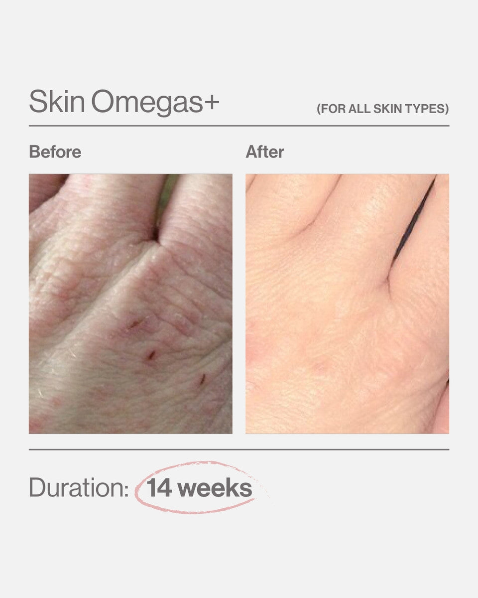 Skin Omegas+ before and after for supporting smooth, hydrated, and luminous-looking skin from within.