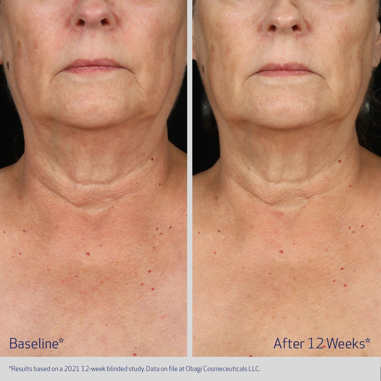 Obagi ELASTIderm Neck and Décolleté Concentrate before and after for neck and chest, advanced formula for visibly firmer, smoother, more youthful-looking skin.