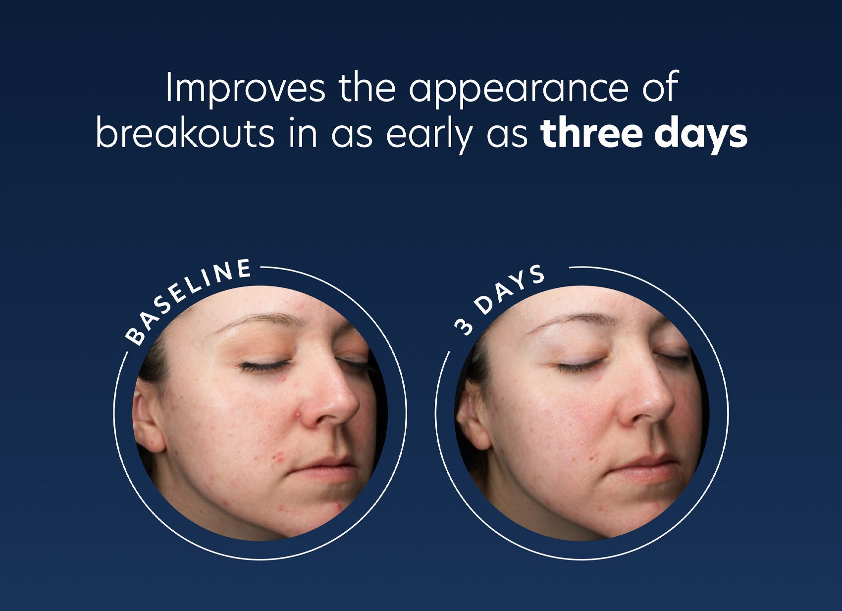 Acne Gel Advanced Treatment