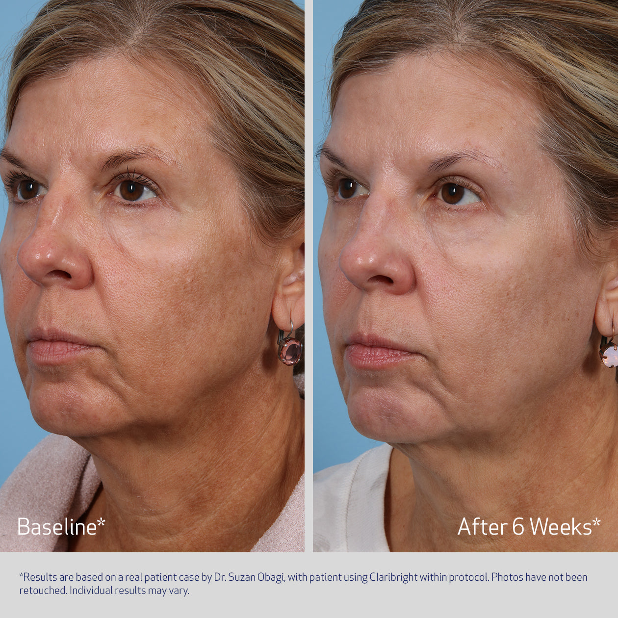 SUZANOBAGIMD Claribright brightening lotion by Obagi for photodamage, redness, and hyperpigmentation. Before and after.