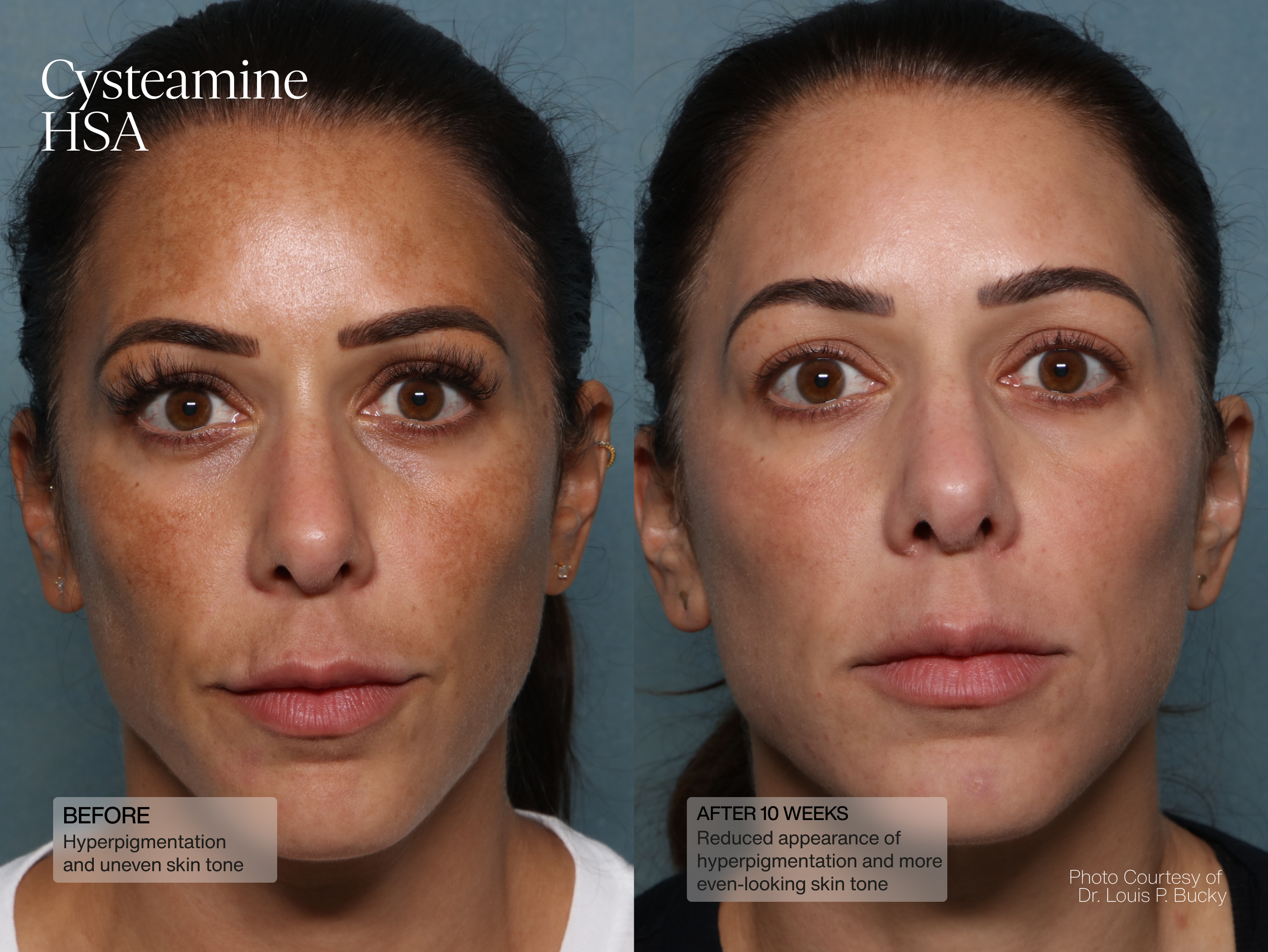 Cysteamine HSA Pigment & Tone Corrector results—visible improvement in skin tone and pigment correction.