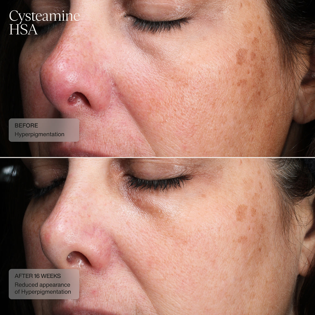 Visible fading of uneven skin tone after treatment with Cysteamine HSA Pigment & Tone Corrector by Senté.
