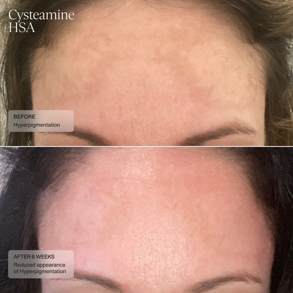 Before and after photos demonstrating effectiveness of Senté Cysteamine pigment corrector on hyperpigmentation.