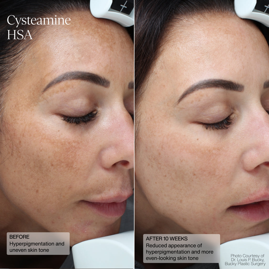 Before and after using Senté Cysteamine HSA Pigment & Tone Corrector showing reduction in dark spots.