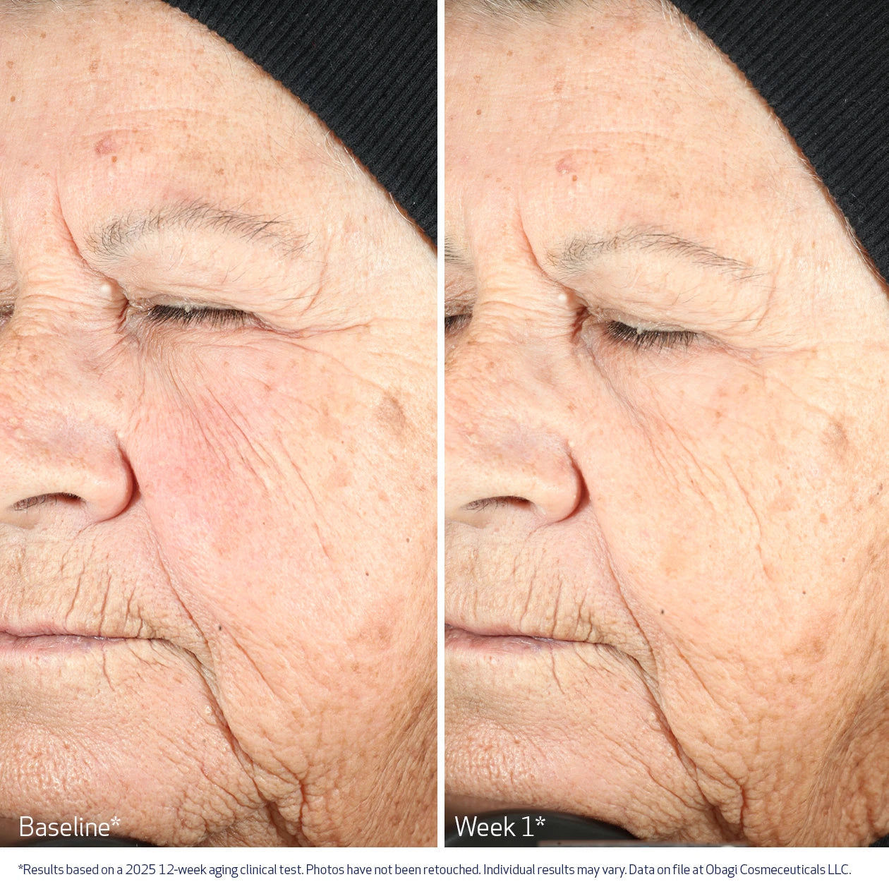 Before and after 1 week comparison of a person's face with visible aging signs, showing improvement over time with Obagi Medical Nu-Gen Cellular Renewal Serum.