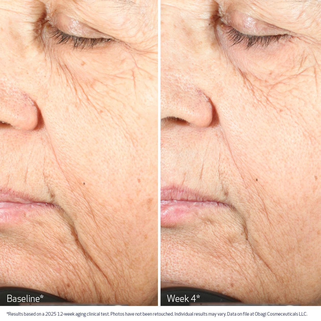Before and after 4 weeks comparison of a person's face with visible aging signs, showing improvement over time with Obagi Medical Nu-Gen Cellular Renewal Serum.
