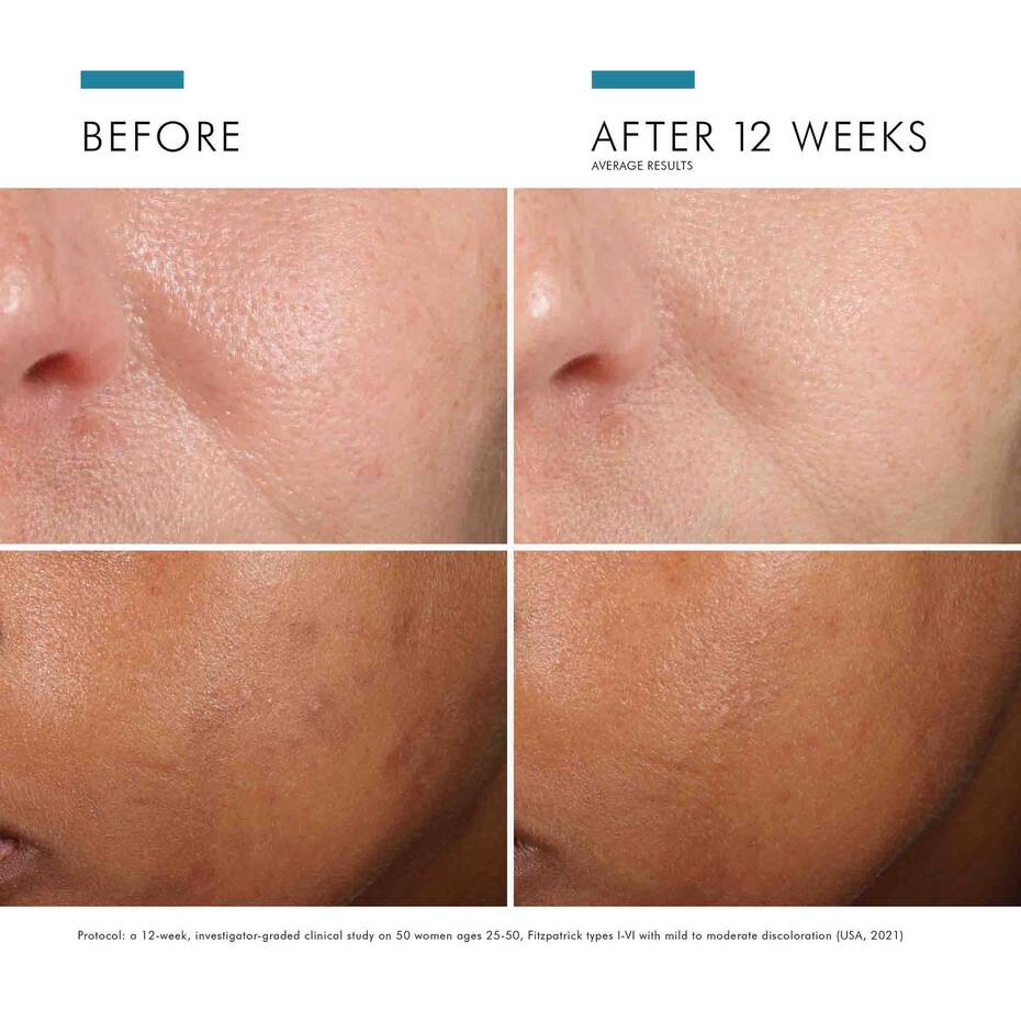 Before/after 12 weeks using Phloretin CF—reduced dark spots, brighter complexion.