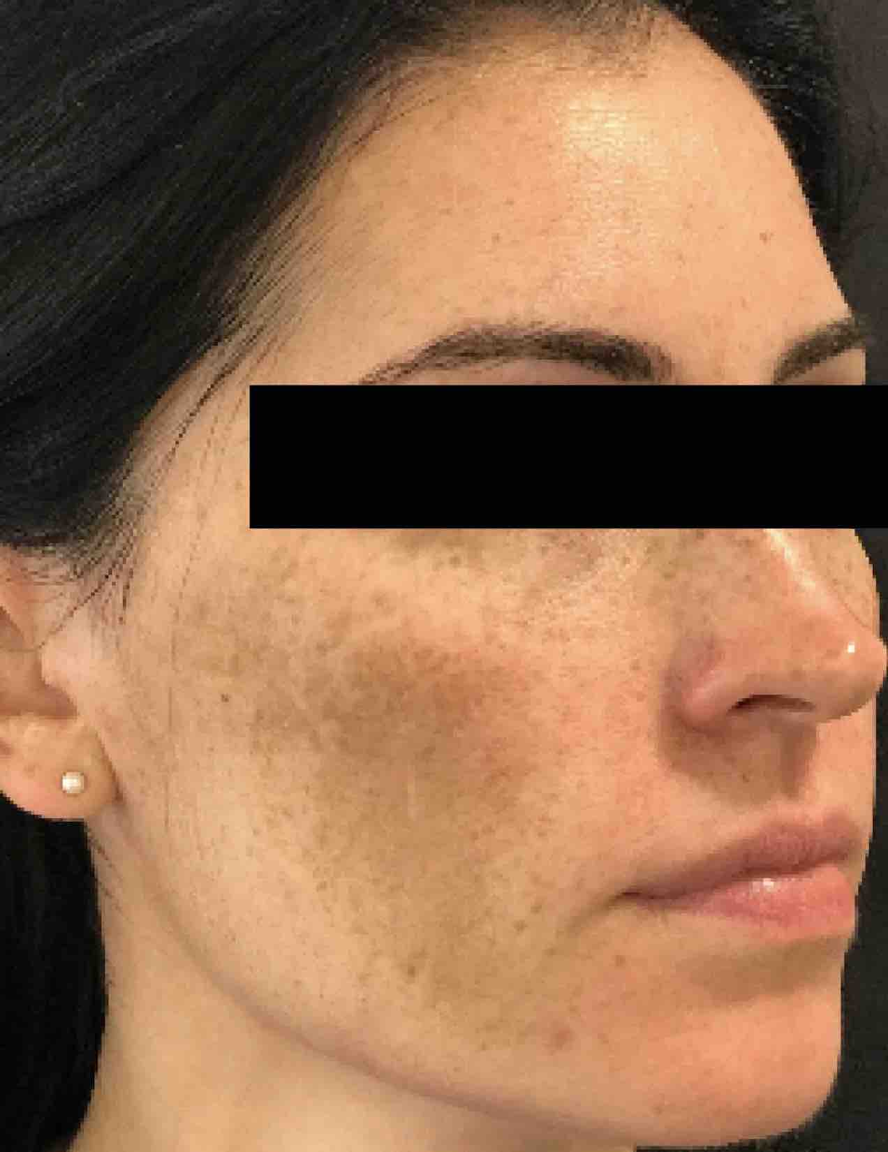 Face shot of a woman before her medical-grade skincare treatments