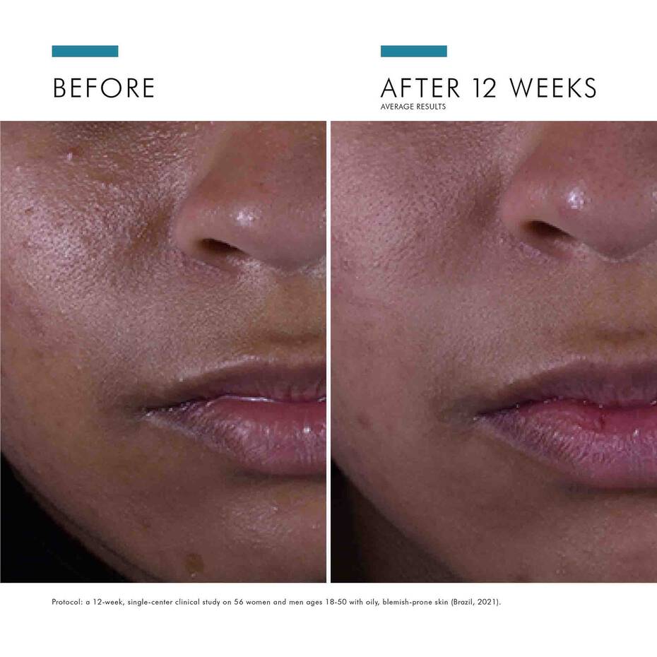 Before/after 12 weeks using Silymarin CF—reduced oiliness, clearer complexion, smoother texture.