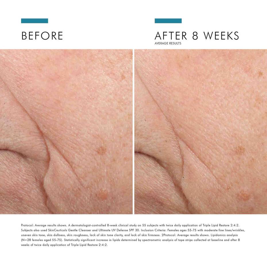 Before/after 8 weeks Triple Lipid Restore—smoother texture, reduced fine lines and pores.