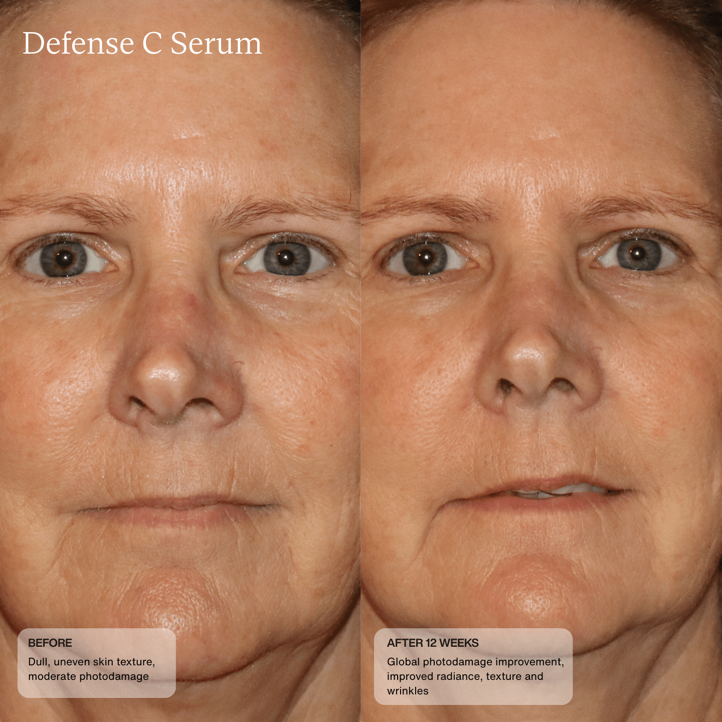 Before and after 12 weeks using Sente Defense C Serum—visible improvement in redness, texture, and overall skin clarity.