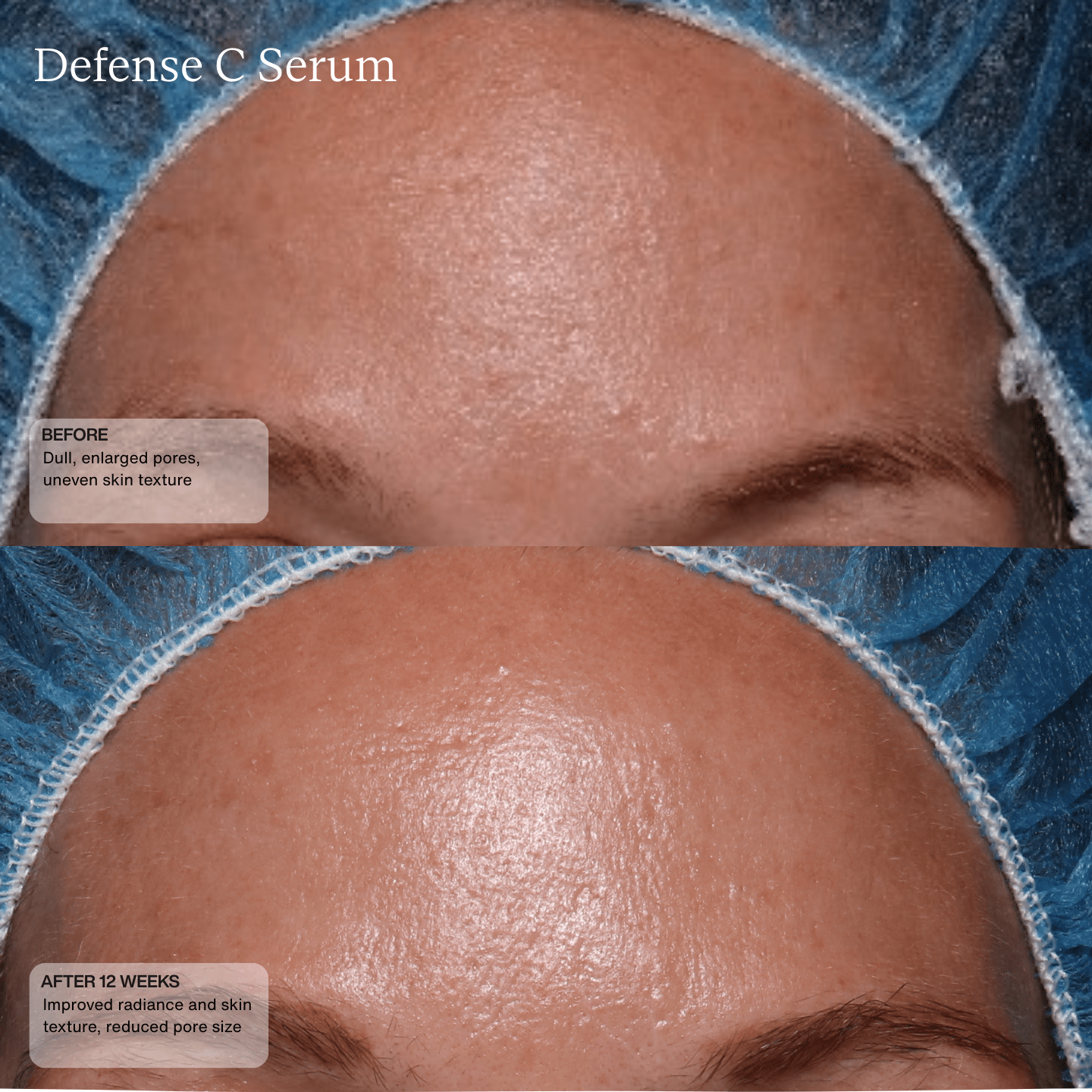 Before and after 12 weeks using Sente Defense C Serum—visible improvement in redness, texture, and overall skin clarity.