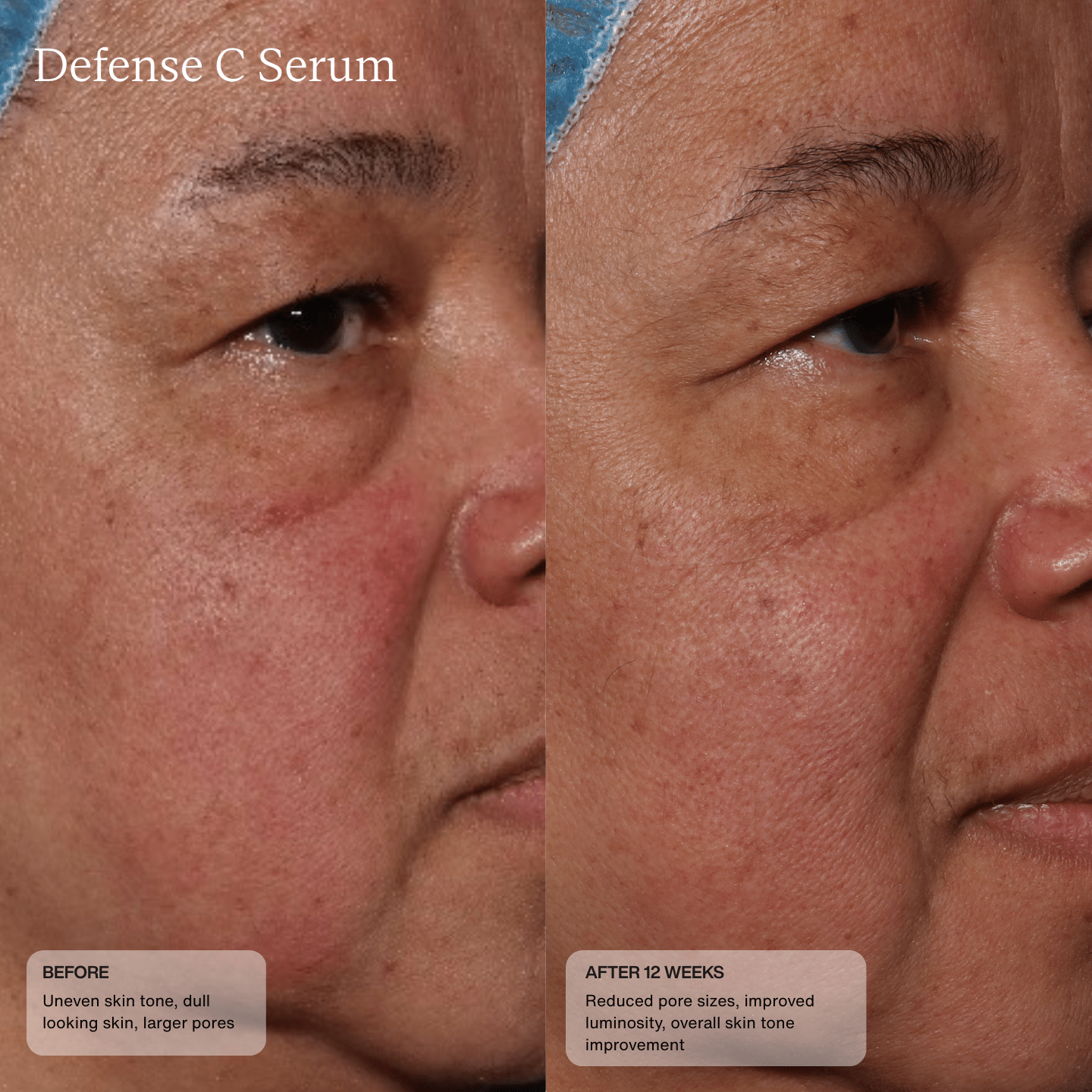 Close-up before and after of cheeks with Sente Defense C Serum—calmer, smoother, more even skin with enhanced barrier resilience.
