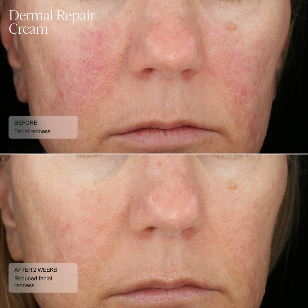 Visible skin recovery and enhanced moisture after treatment with Dermal Repair Cream by Senté.