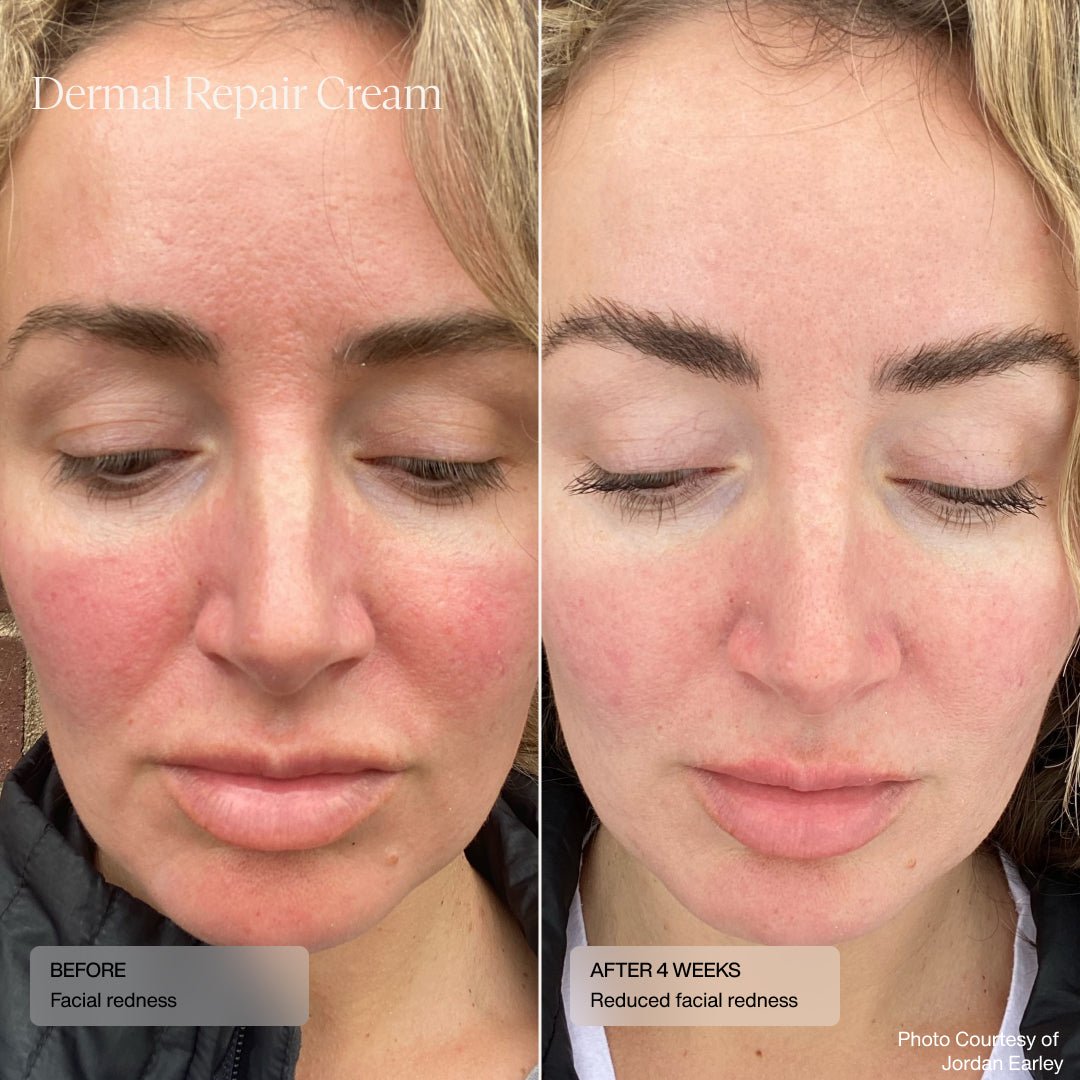 Before and after using Senté Dermal Repair Cream showing improved skin hydration and barrier repair.
