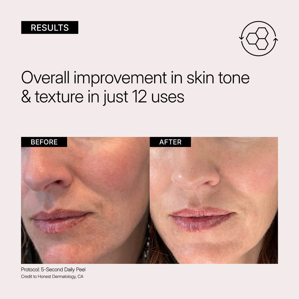 Before and after comparison of skin tone and texture improvement with 12 uses, showing a woman's face with use of Neova 5-Second Daily Peel.