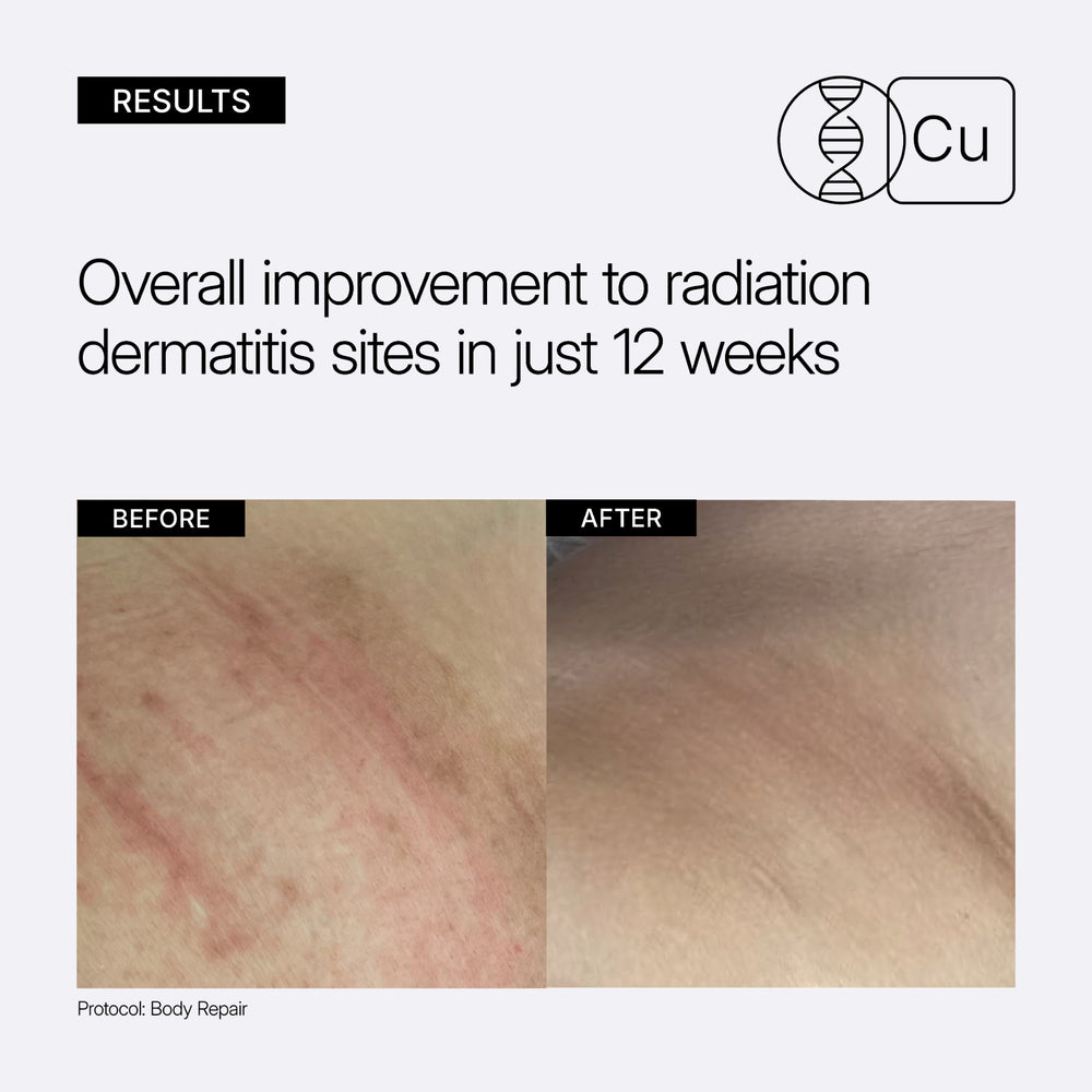 Before and after comparison of radiation dermatitis sites with text indicating improvement in 12 weeks. NEOVA Body Repair lotion for nourishing and repairing dry, sun-exposed body skin.
