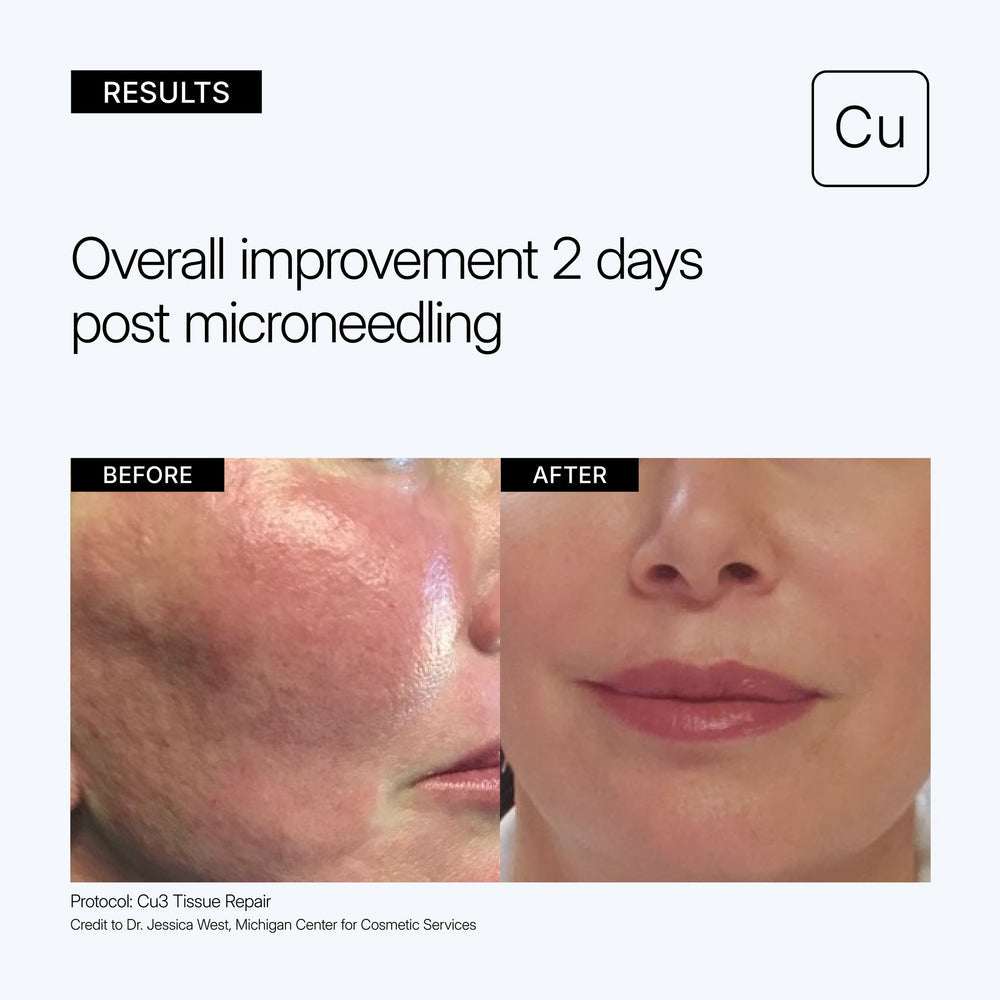 Before and after comparison of skin improvement 2 days post microneedling, showing a visible reduction in scarring with the use of Neova Cu3 Tissue Repair.