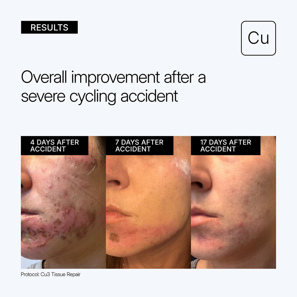 Before and after images of a person's face showing improvement after a severe cycling accident, with text indicating the duration of each stage with the use of Neova Cu3 Tissue Repair.