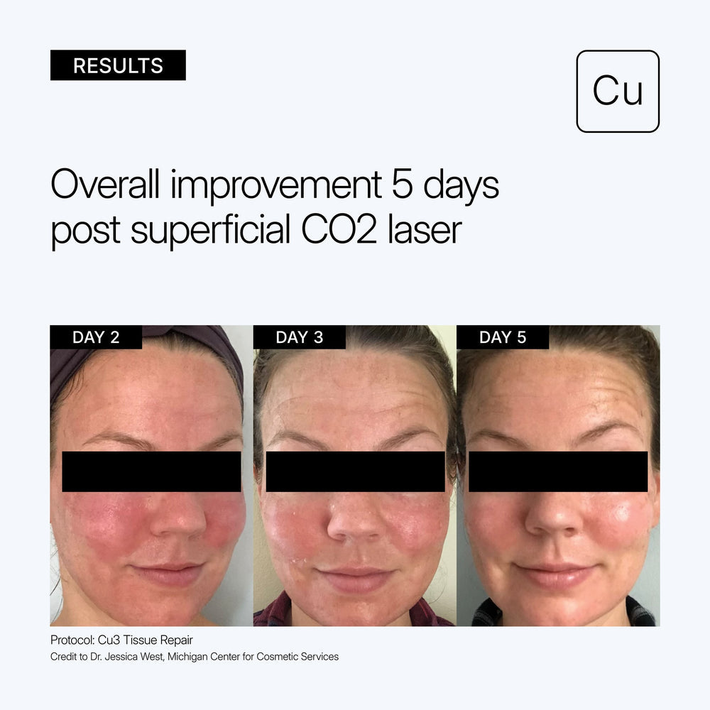 Results graphic showing three facial close-ups labeled Day 2, Day 3, and Day 5 after superficial CO2 laser treatment, with text reading 'Overall improvement 5 days post superficial CO2 laser' and a 'Cu' badge on a light gray background with use of Neova Cu3 Tissue Repair.