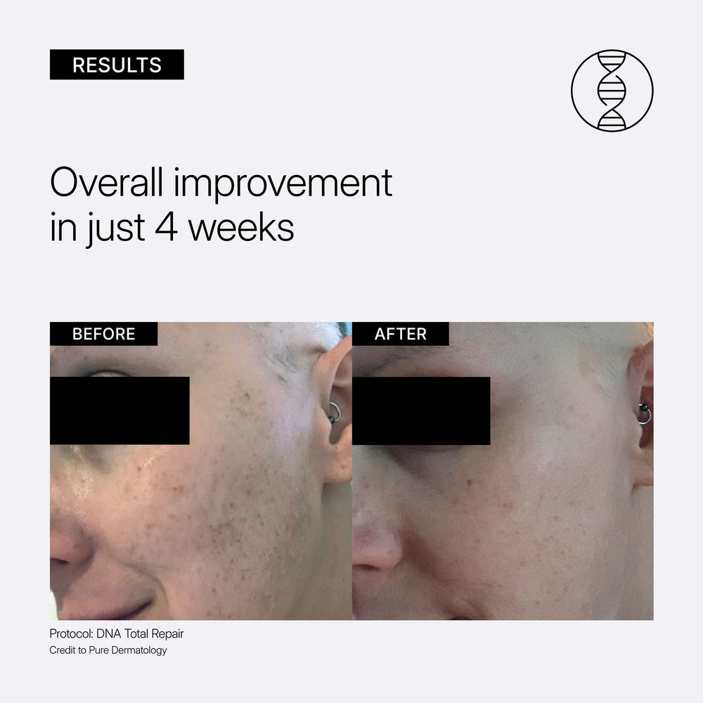 Before and after comparison of skin improvement with Protocol DNA Total Repair, showing overall improvement in just 4 weeks.