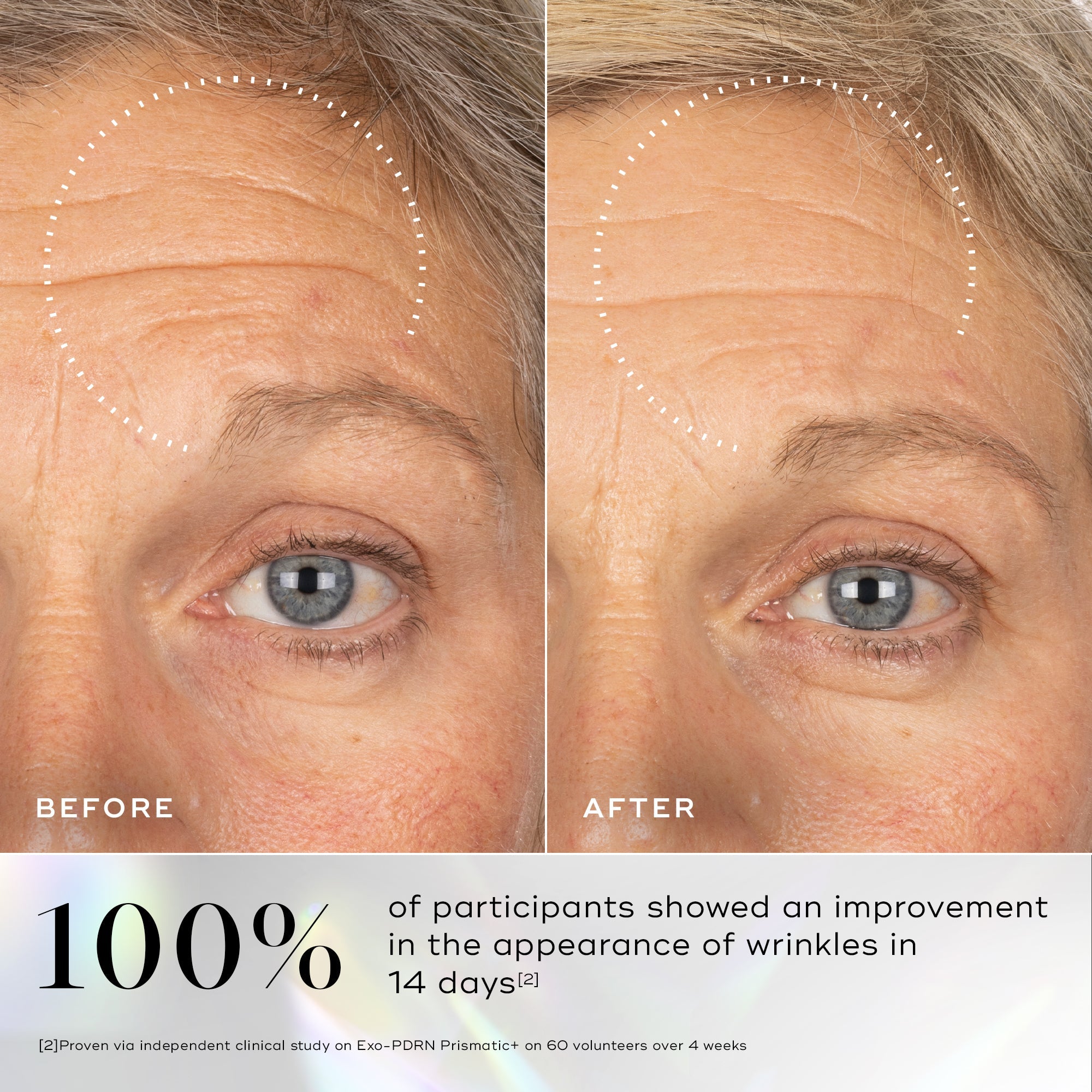 Before and after comparison of a person's face with wrinkles, showing a 100% improvement in appearance of wrinkles in 14 days with Medik8 Exo-PDRN Prismatic+ Serum.