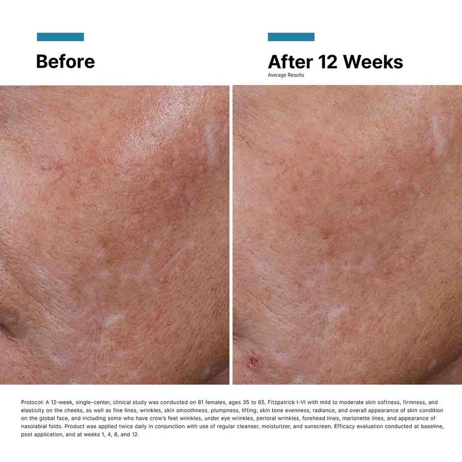 Before/after 12 weeks with HA Intensifier—filled fine lines, stronger facial contours.