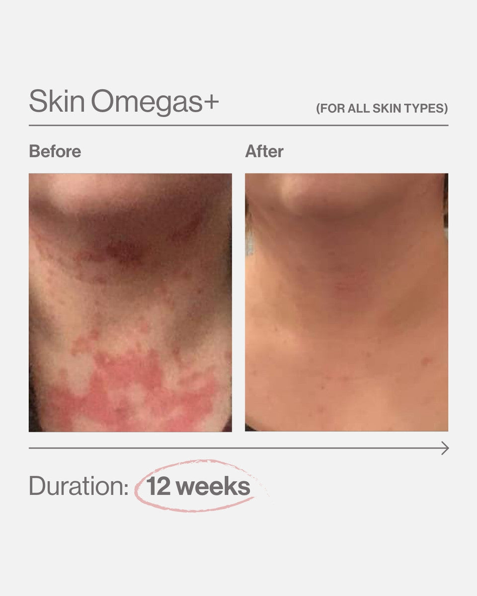 Skin Omegas+ before and after for supporting smooth, hydrated, and luminous-looking skin from within.