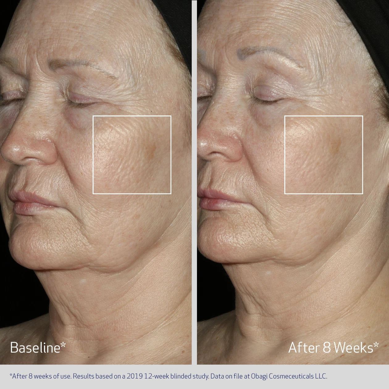 Obagi ELASTIderm Facial Serum before and after, featuring improvements in wrinkles, advanced facial firming treatment for more contoured, youthful-looking skin.