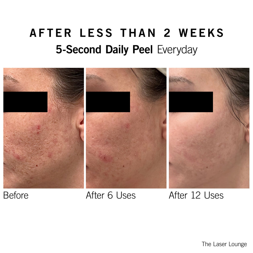 Before and after effects of a Neova 5-second daily peel over 12 uses on skin texture.