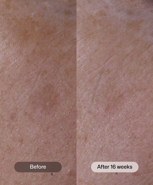 Close-up before-and-after skin comparison showing a 16-week improvement, with the left panel labeled 'Before' and the right panel labeled 'After 16 weeks'. Revision Advanced Pigment Corrector+™ for brighter, clearer, more even-looking skin and reduced post-blemish marks.