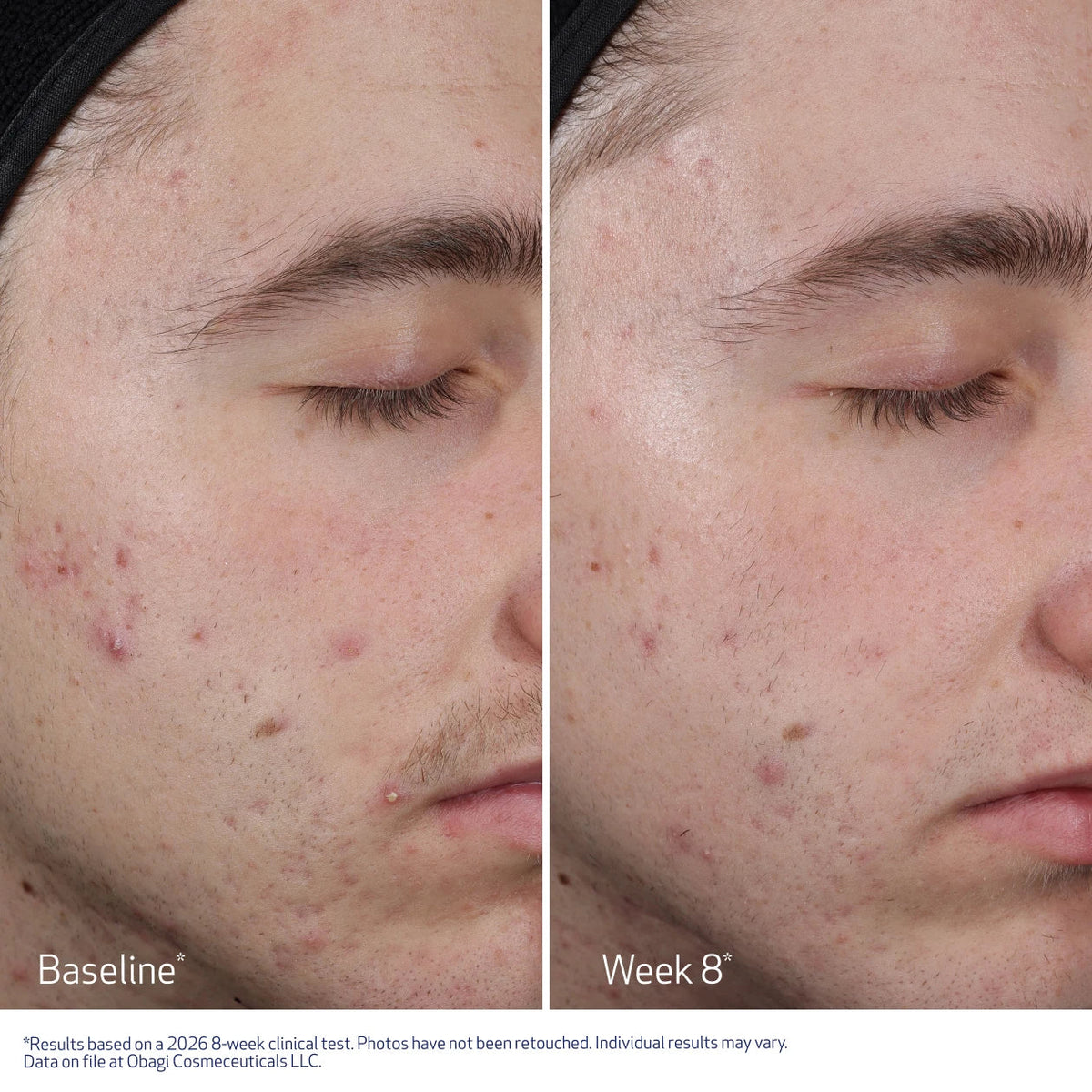 Side-by-side facial skin comparison of the same person's cheek and jawline, labeled 'Baseline' on the left and 'Week 8' on the right, showing improvement in acne and blemishes. Obagi CLENZIderm Multi-Acid Peel Pad.