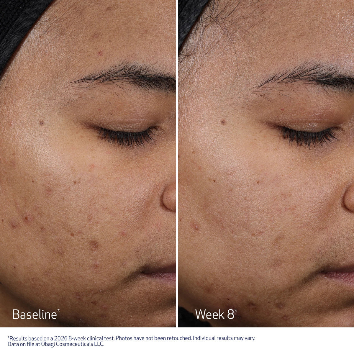 Before and after of Dual-sided Lyocell Obagi CLENZIderm peel pad for even application and controlled exfoliation. 
