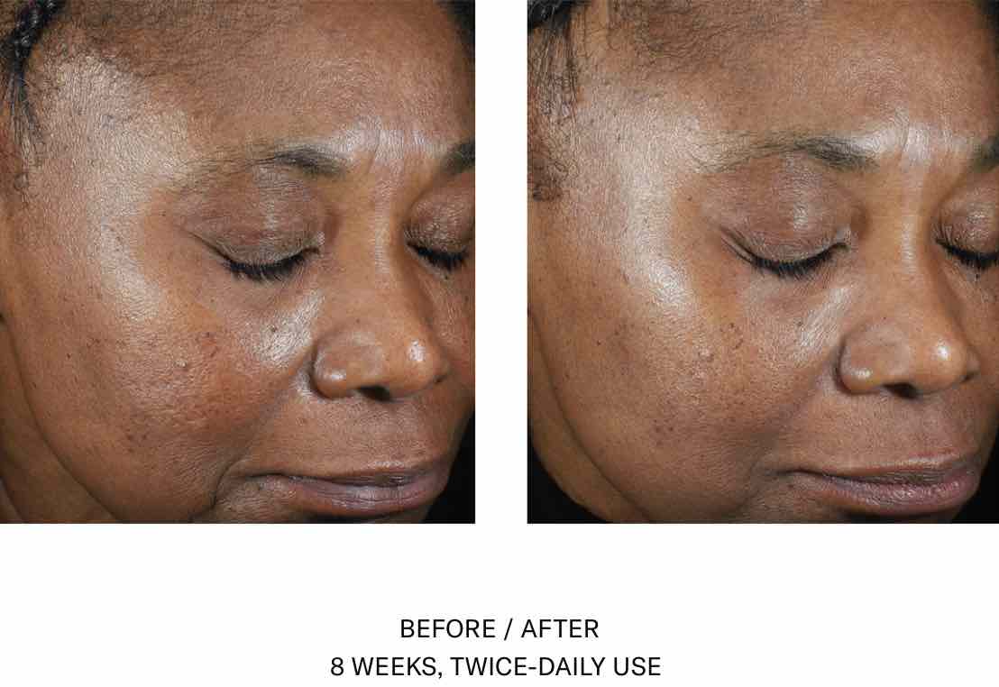 skinbetter Trio Luxe Moisture Treatment. Before After. Official UK Stockist. Worldwide shipping. Medical-grade skincare. The M-ethod Aesthetics
