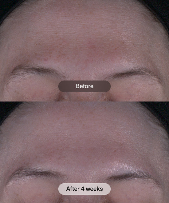 A close-up before-and-after comparison of a person's forehead showing skin improvement after 4 weeks. The top panel is labeled 'Before' and shows visible freckles and uneven tone, while the bottom panel is labeled 'After 4 weeks' and shows a smoother, more even complexion. Revision Tone+ Correcting Pads™ formulated with glycolic, lactic, mandelic, citric, and phytic acids.