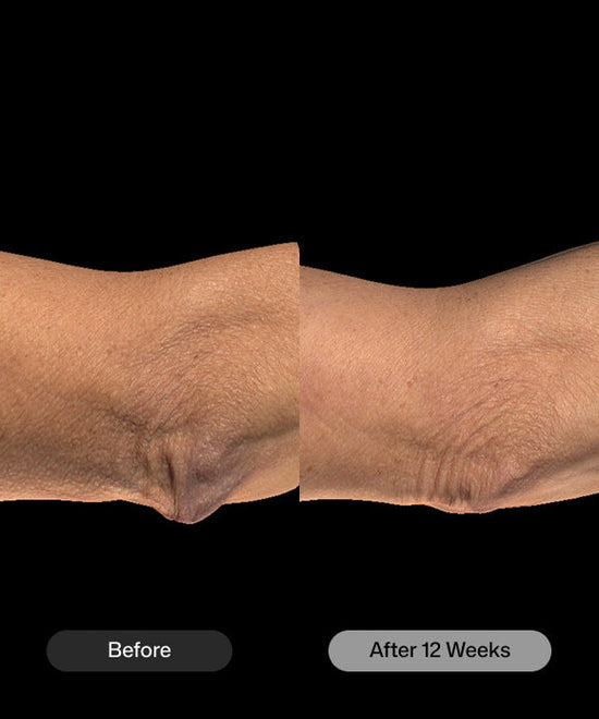 Before and after comparison of skin texture on a forearm, labeled 'Before' and 'After 12 Weeks' on a black background for Revision BodiContour.