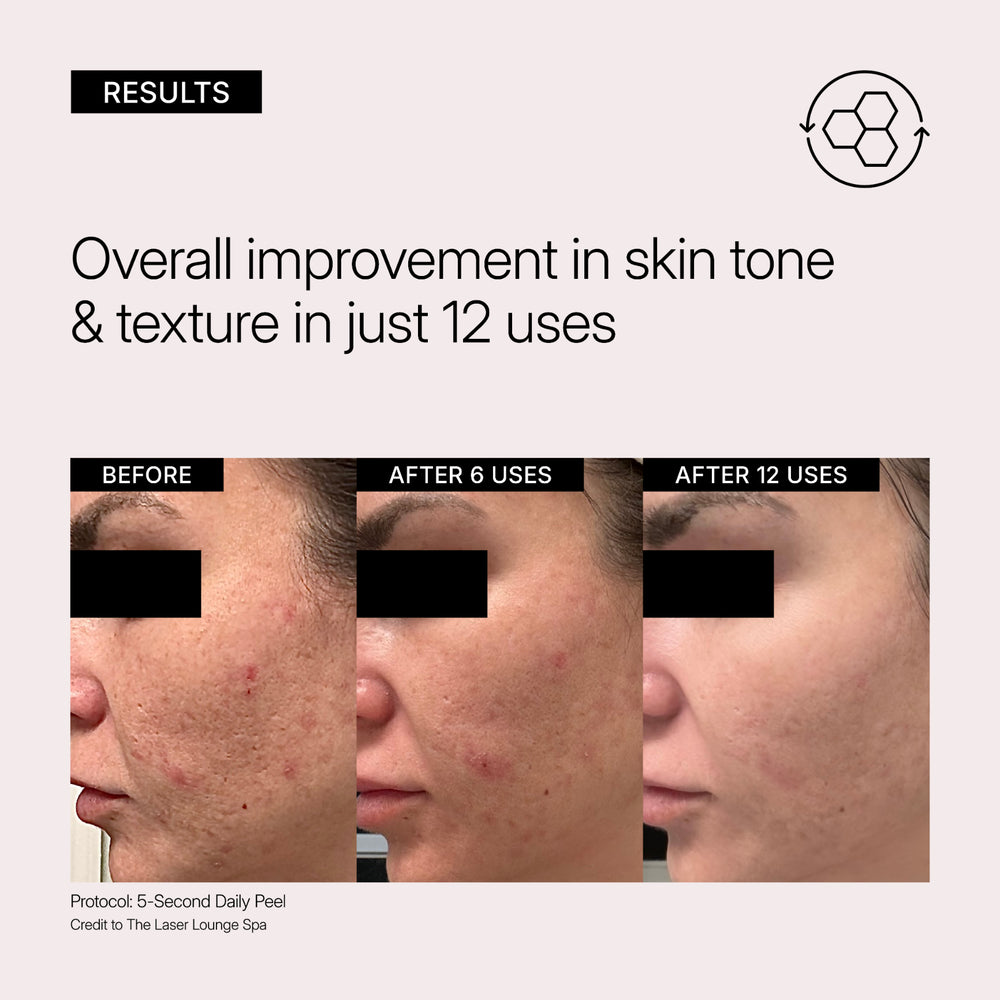 Before and after skin improvement results using a Neova 5-Second Daily Peel protocol.