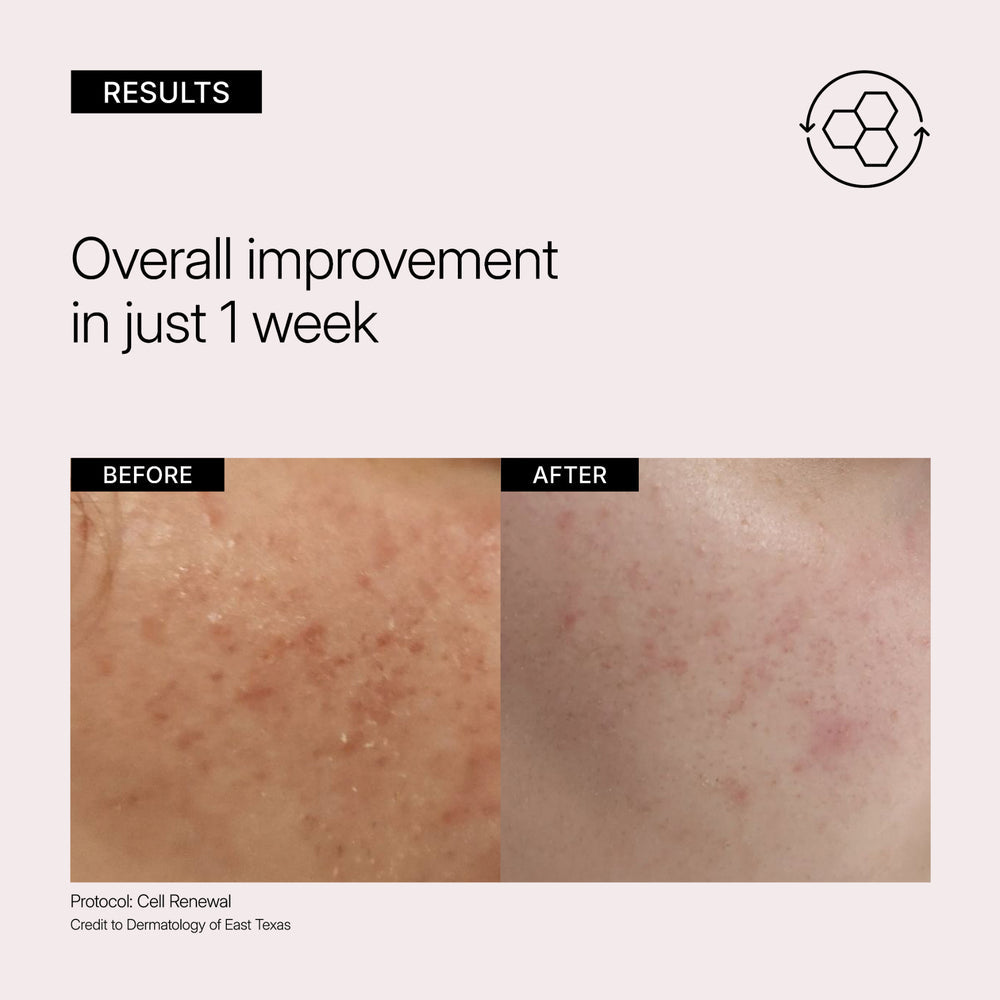 Before and after skin improvement results showing a reduction in blemishes on skin. NEOVA Cell Renewal Serum to face, skincare for visible sun damage and uneven texture