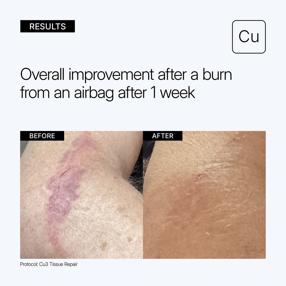 Before-and-after skin comparison showing burn recovery after one week, with text reading 'Overall improvement after a burn from an airbag after 1 week' and a 'Cu' label on a light gray background with the use of Neova Cu3 Tissue Repair.
