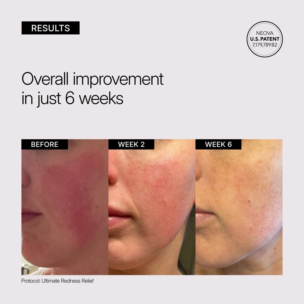Before and after skin improvement results showing reduction of redness over 6 weeks with Neova Ultimate Redness Relief.