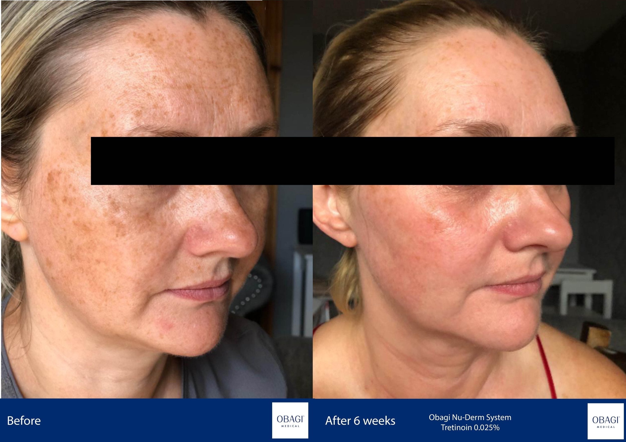 Nu-Derm Skin Transformation System - Normal to Oily. Before After. Obagi Medical. Worldwide international shipping. Official stockist. UK Ambassador Clinic.