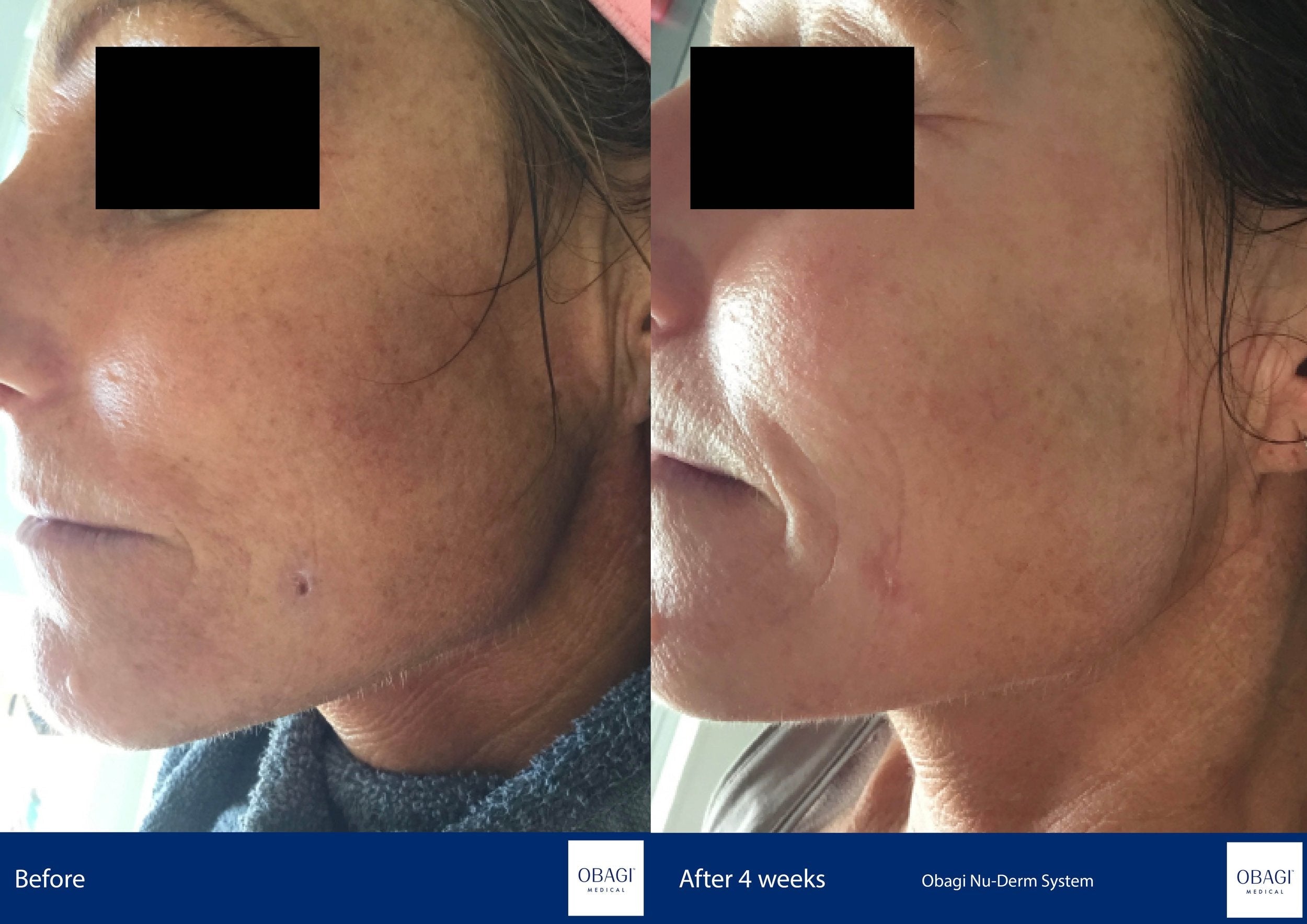 Nu-Derm Travel Kit - Normal to Oily. Before After. Obagi Medical. Worldwide international shipping. Official stockist. UK Ambassador Clinic.