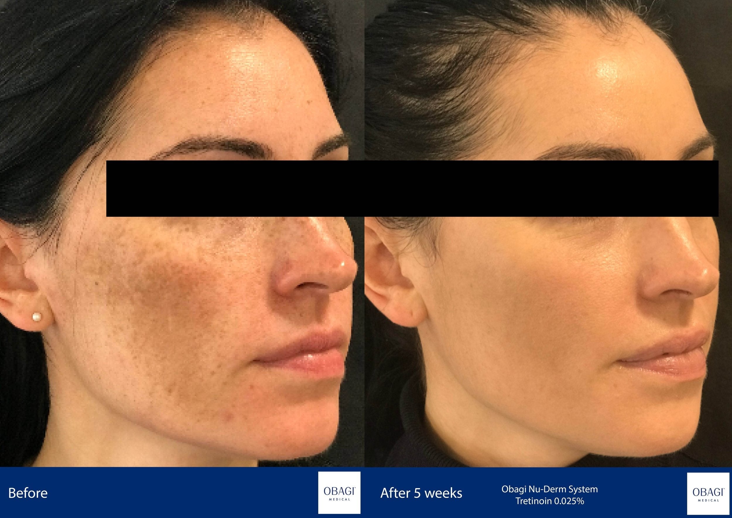 Nu-Derm Travel Kit - Normal to Oily. Before After. Obagi Medical. Worldwide international shipping. Official stockist. UK Ambassador Clinic.