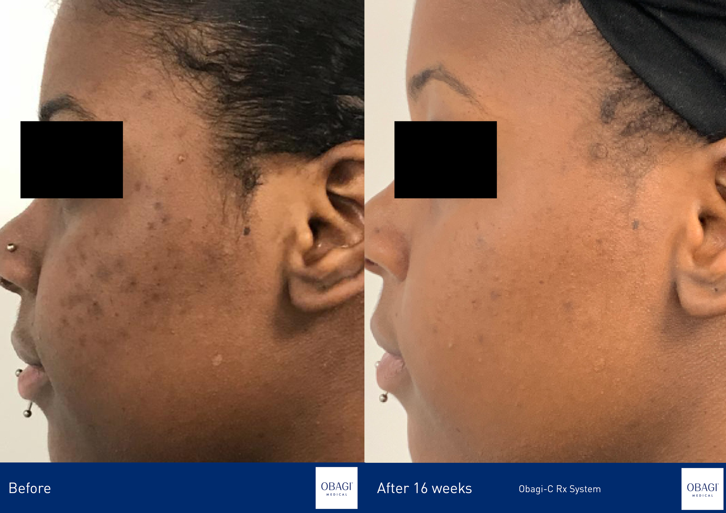 Obagi-C Rx C-Clarifying Serum - Normal to Dry. Before After. Obagi Medical. Worldwide international shipping. Official stockist. UK Ambassador Clinic.